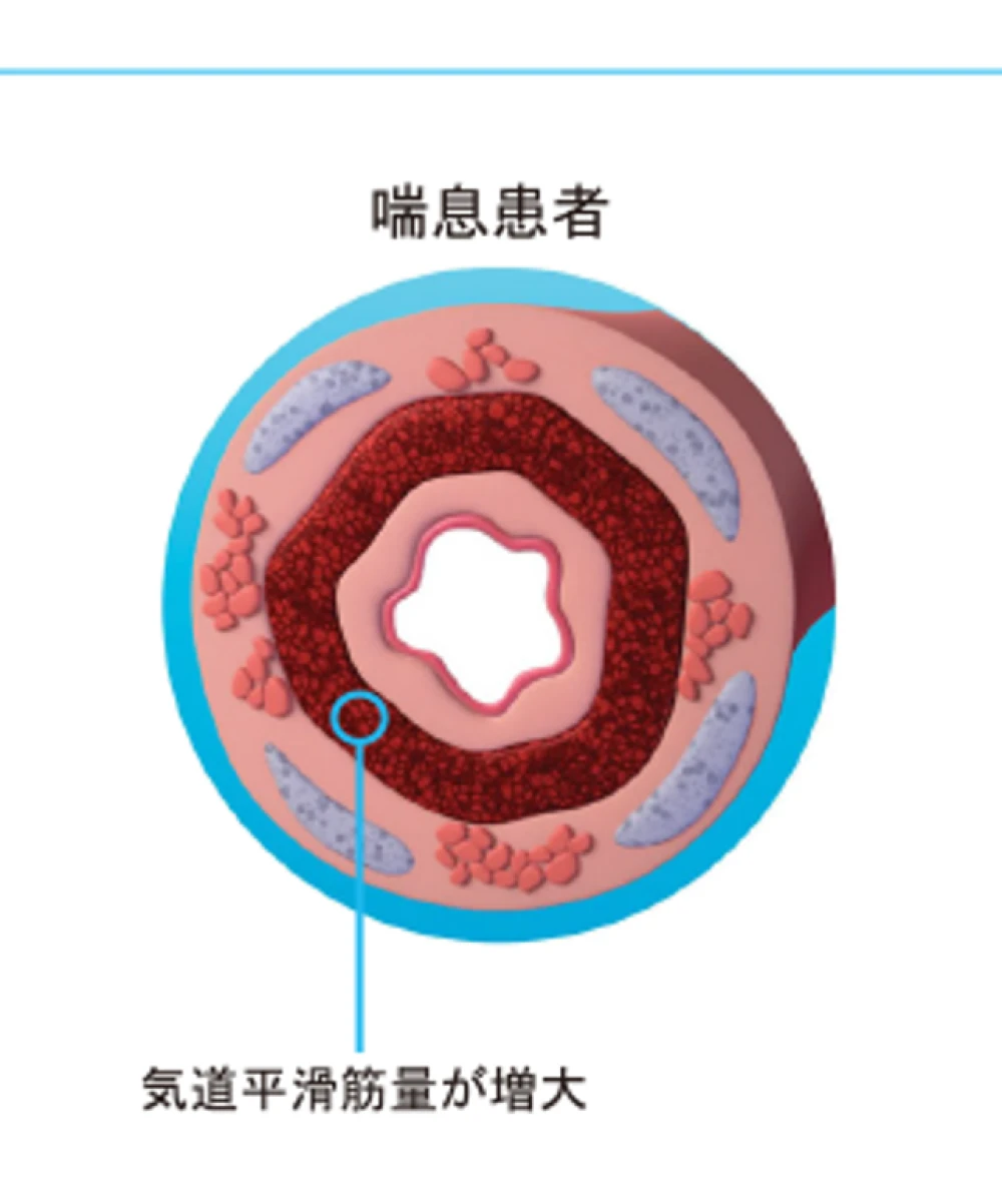 気道断面図 喘息患者