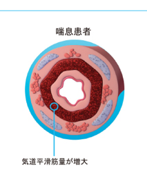気道断面図 喘息患者.jpg