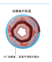 気道断面図 治療後の気道.jpg